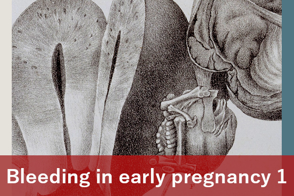 Bleeding in early pregnancy 1