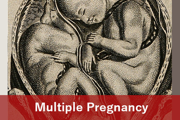 Multiple pregnancy